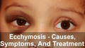 Ecchymosis - Causes, Symptoms, And Treatment - Mama Daily Dose